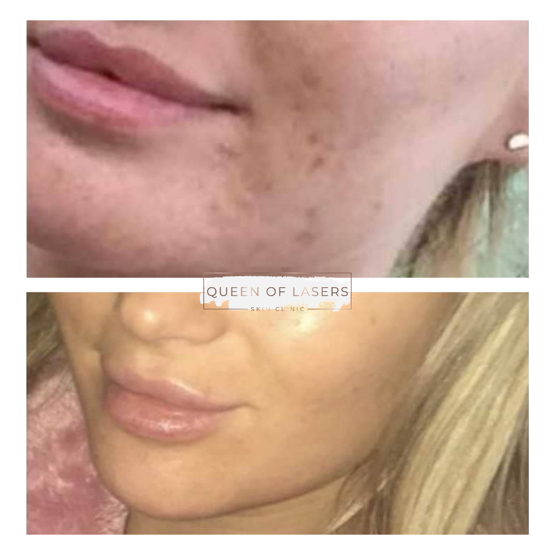Carbon Laser Facial Rejuvenation Queen of Lasers