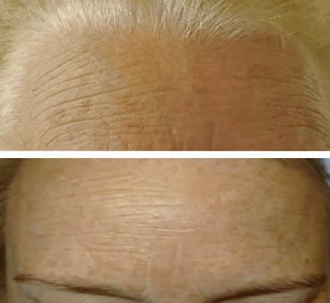 Sun/Age Spot Removal