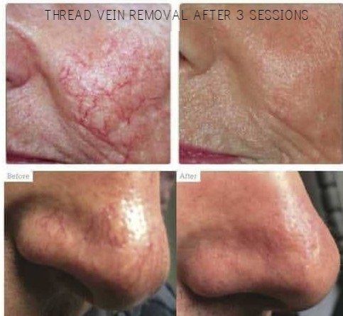 Thread Vein removals