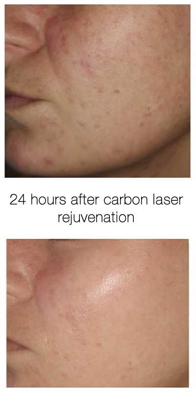 Carbon Facial rejuvenation