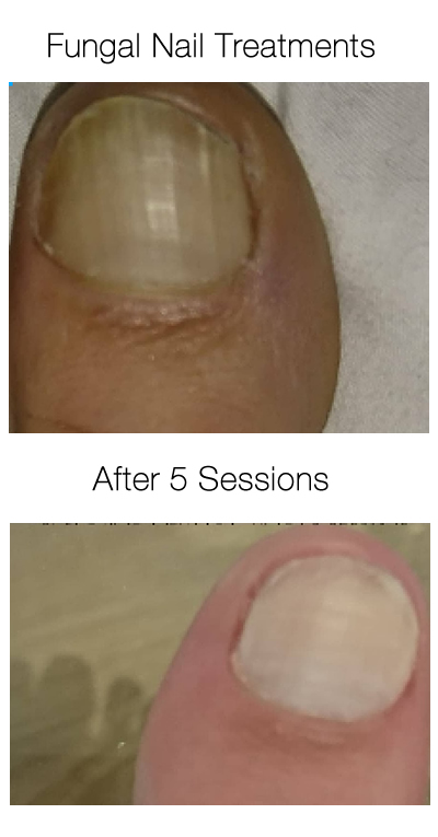 Fungal nail treatments