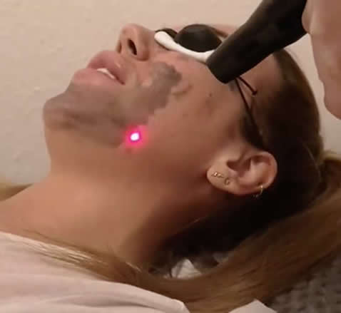 Carbon laser Treatments